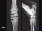 proximal phalanx angular limb deformities