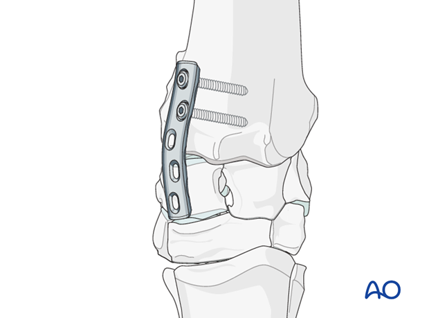partial carpal arthrodesis