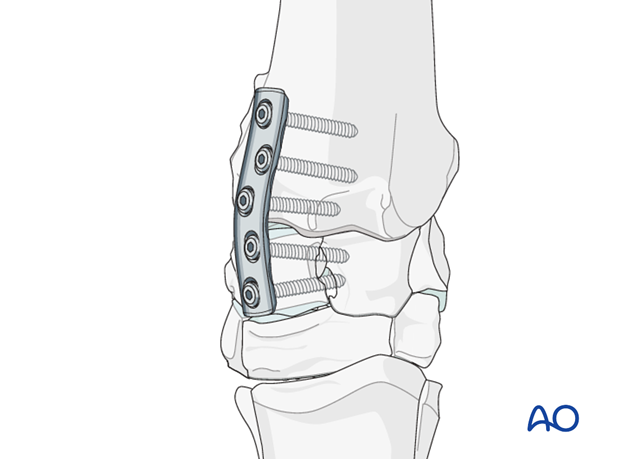 partial carpal arthrodesis