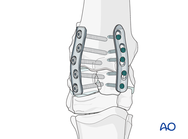 partial carpal arthrodesis