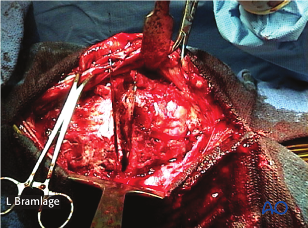 partial carpal arthrodesis
