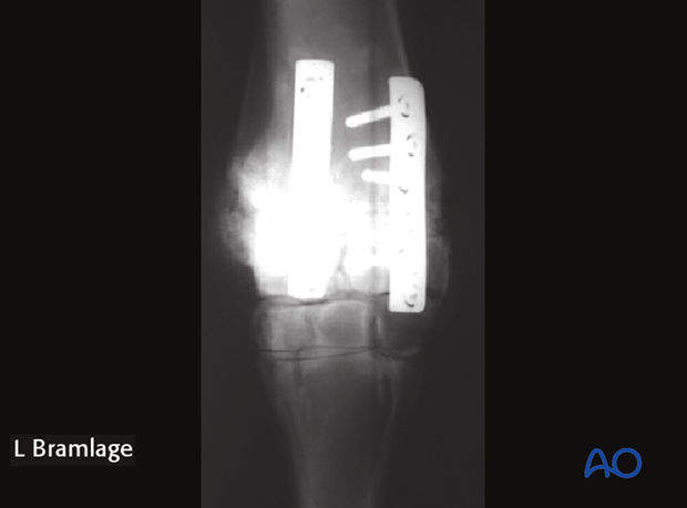 partial carpal arthrodesis