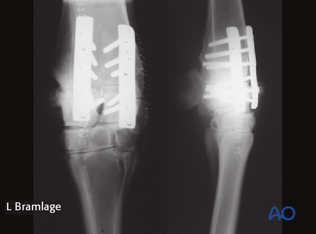 partial carpal arthrodesis