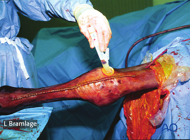 partial carpal arthrodesis