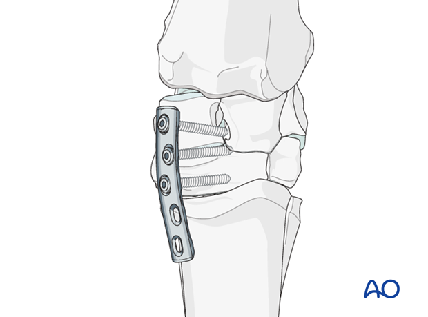 partial carpal arthrodesis