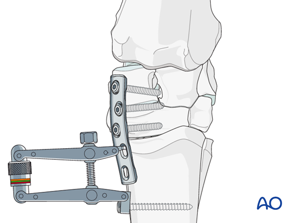 partial carpal arthrodesis