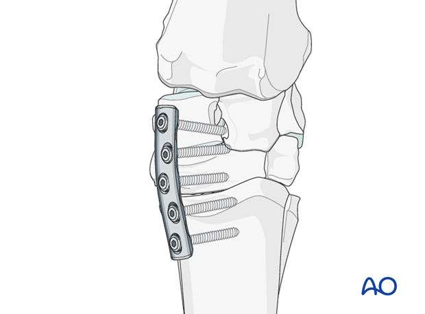partial carpal arthrodesis