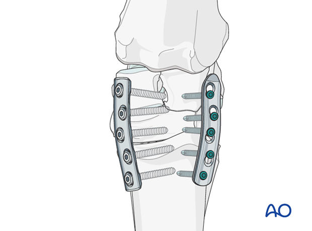 partial carpal arthrodesis