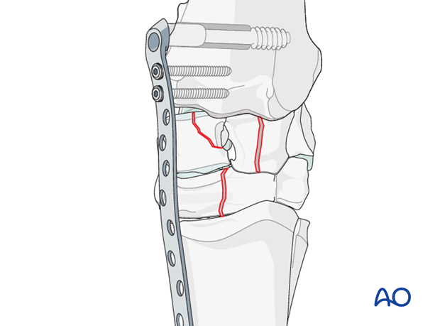 pancarpal arthrodesis