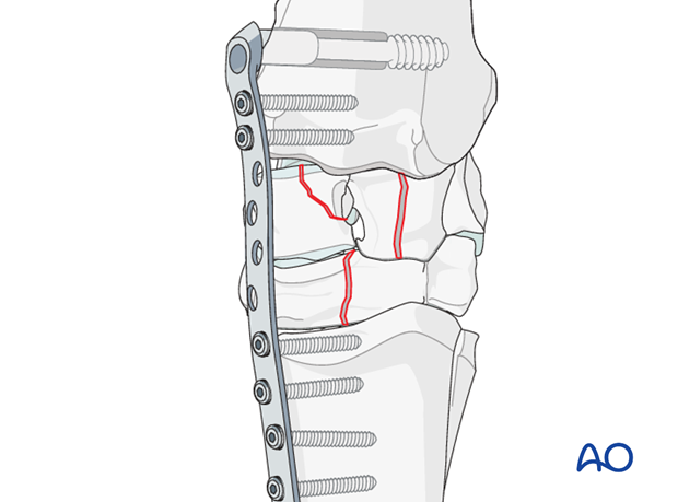 pancarpal arthrodesis