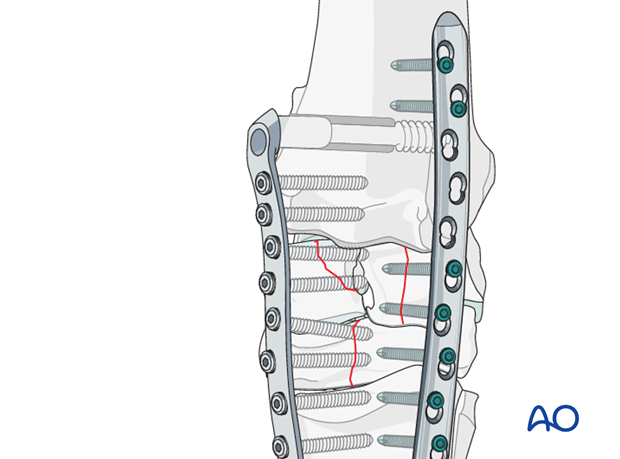 pancarpal arthrodesis