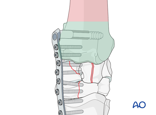 pancarpal arthrodesis