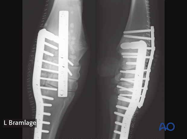 pancarpal arthrodesis