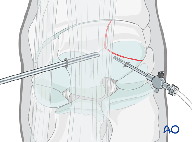 H70_P400_i130 arthroscopic screw fixation
