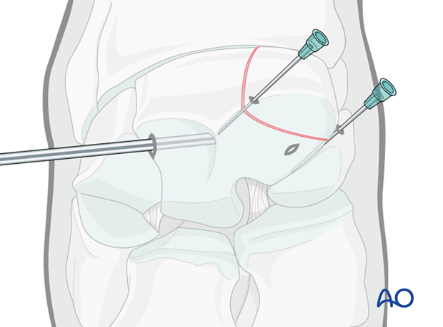 H70_P400_i400 arthroscopic screw fixation