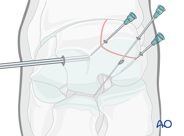 H70_P400_i410 arthroscopic screw fixation