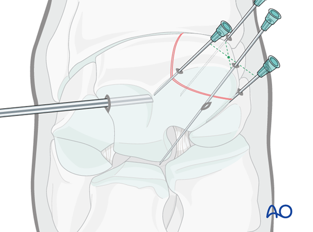 H70_P400_i430 arthroscopic screw fixation
