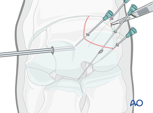 H70_P400_i450 arthroscopic screw fixation