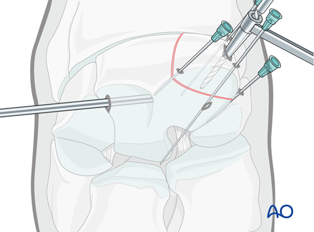 H70_P400_i460 arthroscopic screw fixation