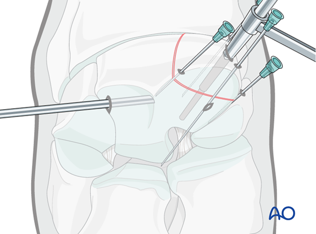 H70_P400_i480 arthroscopic screw fixation