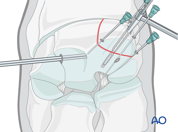 H70_P400_i500 arthroscopic screw fixation