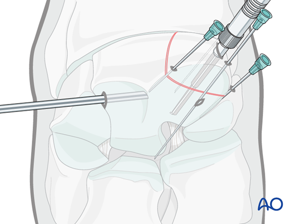 H70_P400_i510 arthroscopic screw fixation