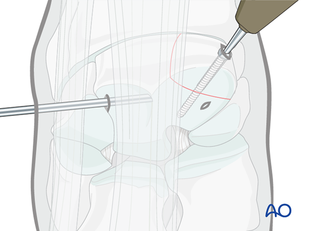 H70_P400_i890 arthroscopic screw fixation