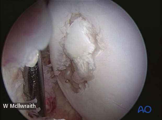 H70_P400_p010 arthroscopic screw fixation