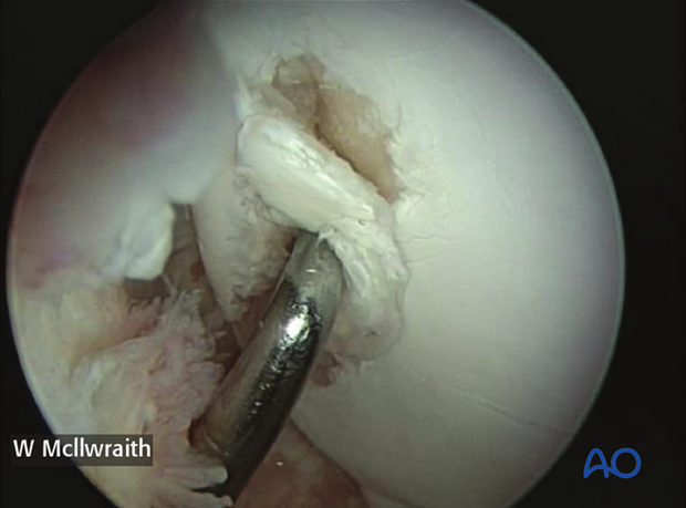 H70_P400_p020 arthroscopic screw fixation