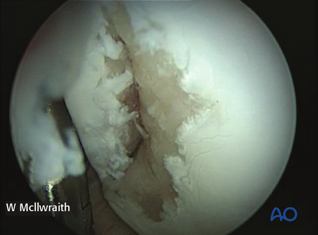 H70_P400_p030 arthroscopic screw fixation