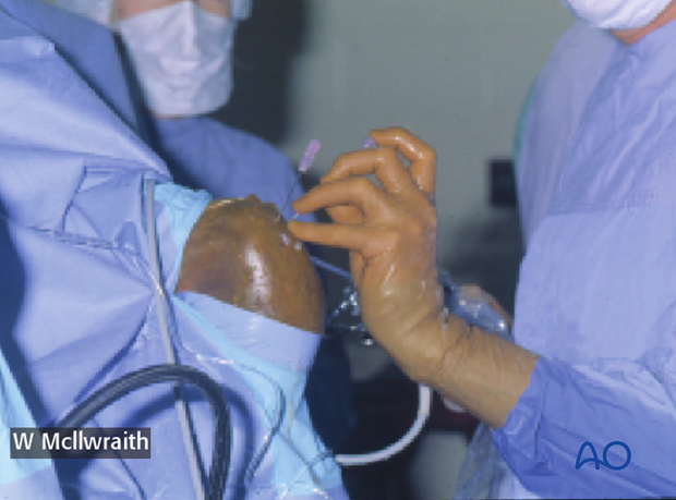 H70_P400_p040 arthroscopic screw fixation