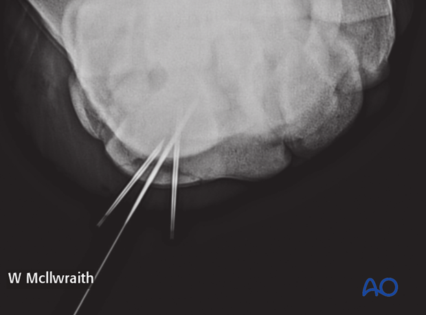 H70_P400_p060 arthroscopic screw fixation