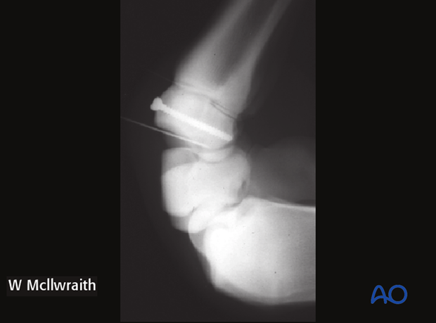 H70_P400_p080 arthroscopic screw fixation