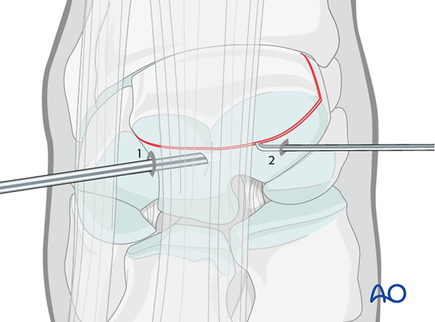 arthroscopic approach