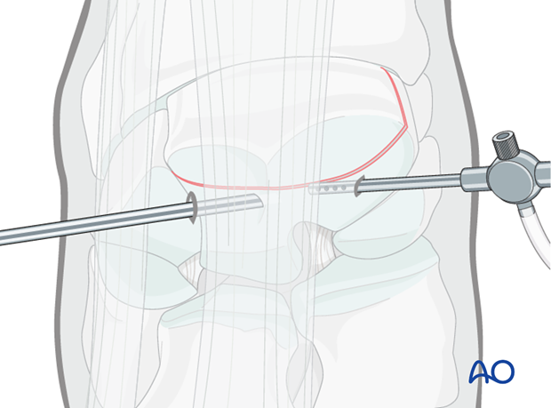 arthroscopic screw fixation