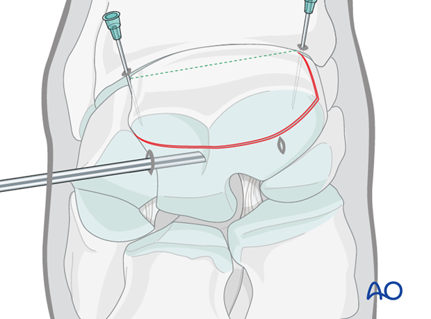 arthroscopic screw fixation