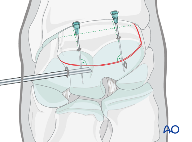 arthroscopic screw fixation
