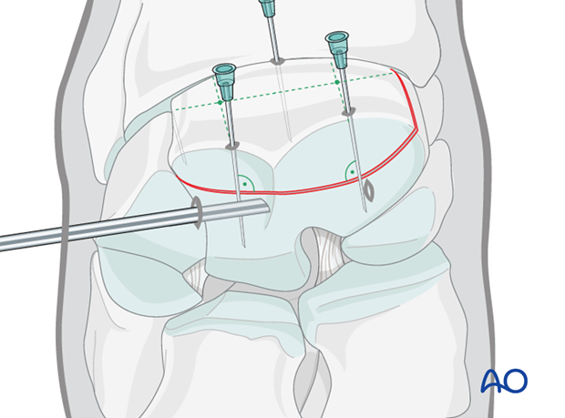 arthroscopic screw fixation