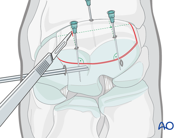 arthroscopic screw fixation