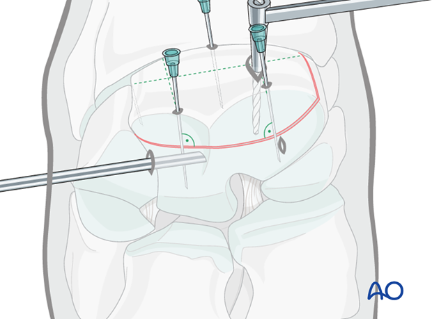 arthroscopic screw fixation