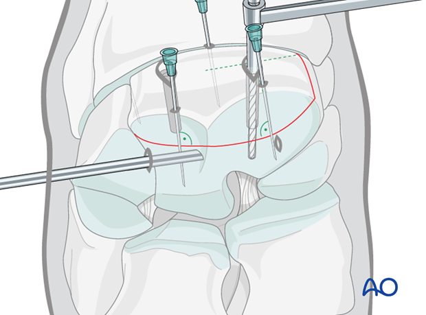 arthroscopic screw fixation