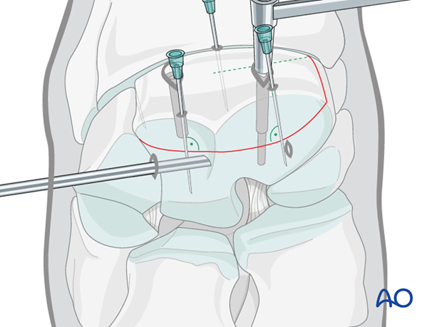 arthroscopic screw fixation