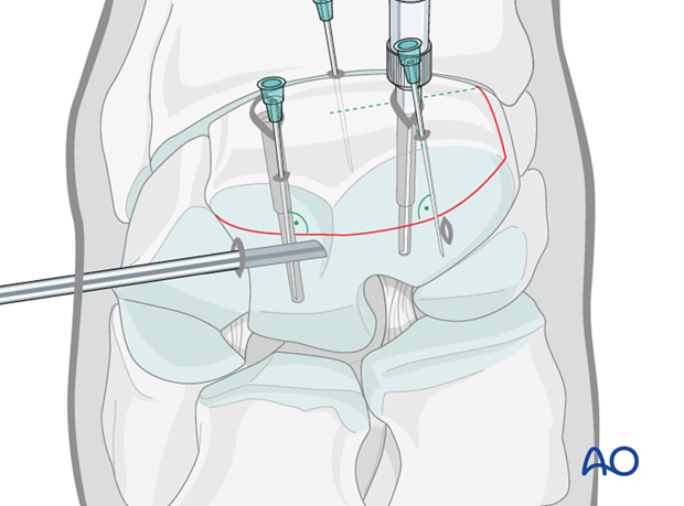 arthroscopic screw fixation
