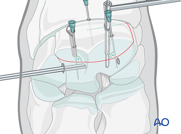 arthroscopic screw fixation