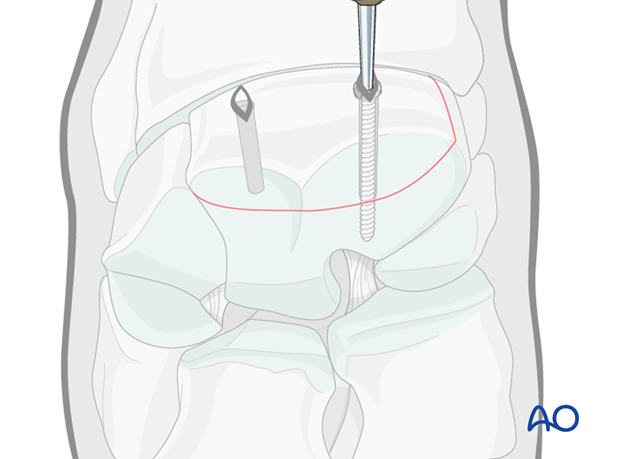 arthroscopic screw fixation