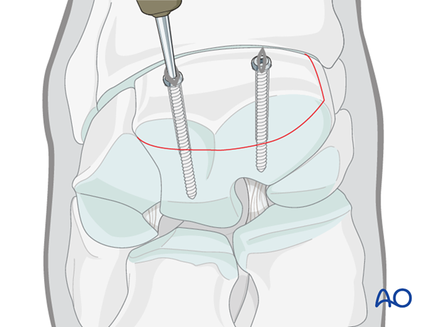 arthroscopic screw fixation