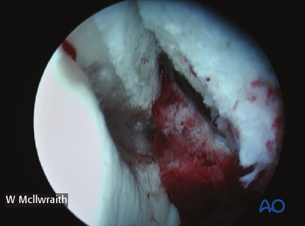 arthroscopic screw fixation