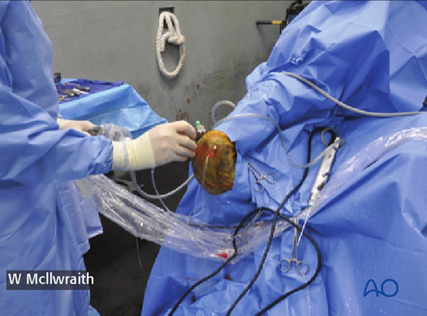 arthroscopic screw fixation