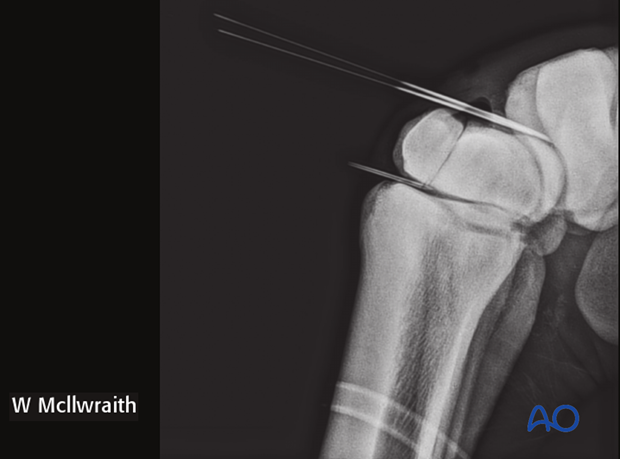 arthroscopic screw fixation