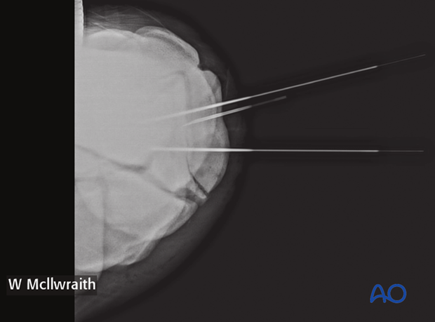 arthroscopic screw fixation